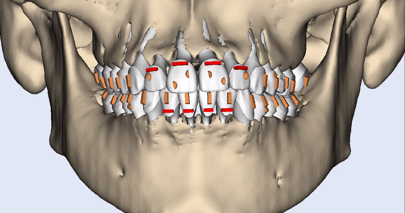 Lime Aligners